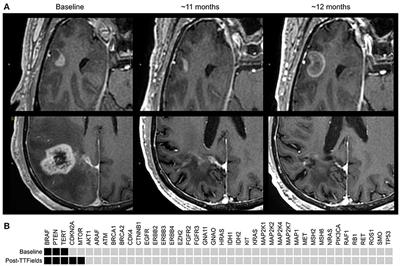 Molecular Evolution of a Glioblastoma Controlled With Tumor Treating Fields and Concomitant Temozolomide